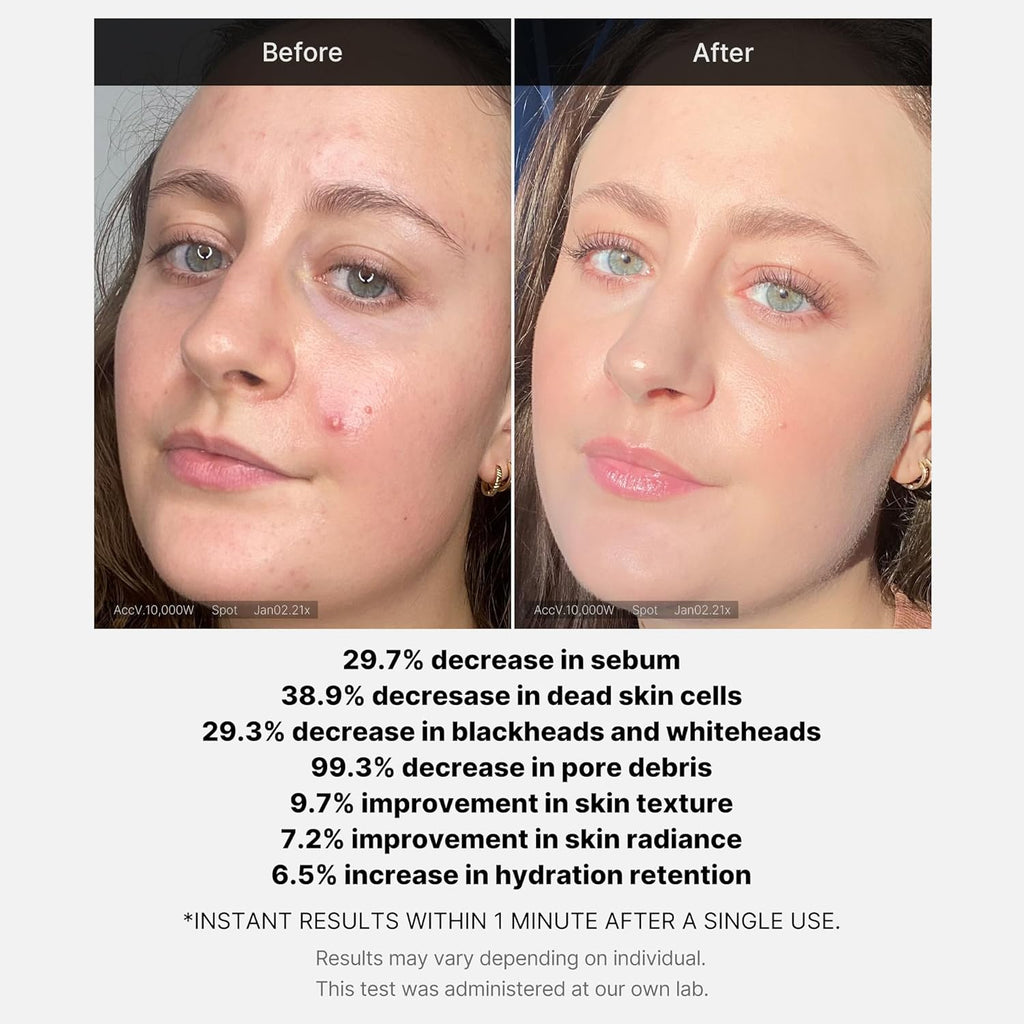 Medicube 1 Min Red Acne Succinic Acid Peel 40 g