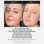 Medicube 1 Min Red Acne Succinic Acid Peel 40 g