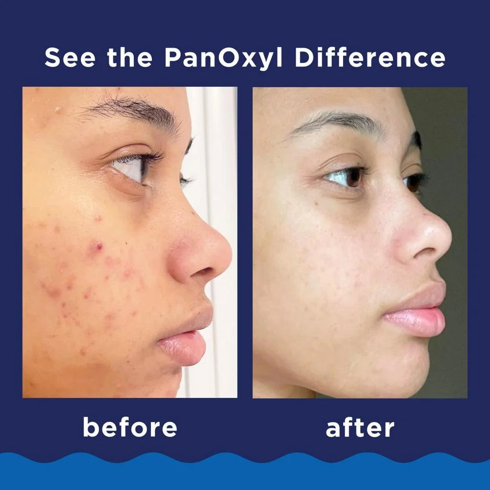 Panoxyl Acne Foaming Wash 10% 156 g