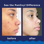 Panoxyl Acne Foaming Wash 10% 156 g